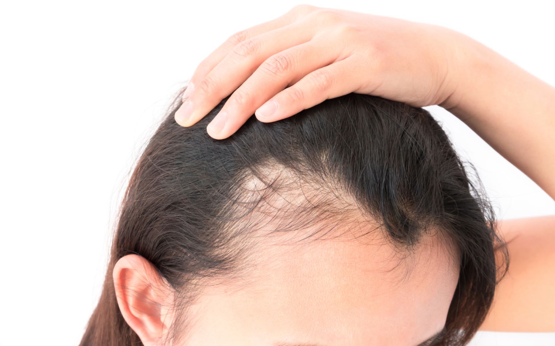 what hormone causes hair loss in females?