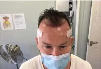 FUE Hair Transplant, Wimpole Clinic